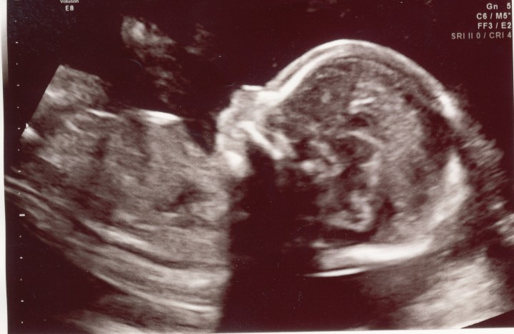 Ultrasound at 19 Weeks for Rhoden Baby #2, Due July 4th.